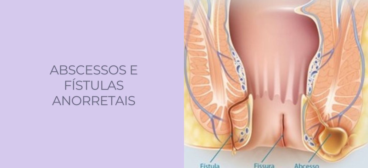 Abcessos e fistulas