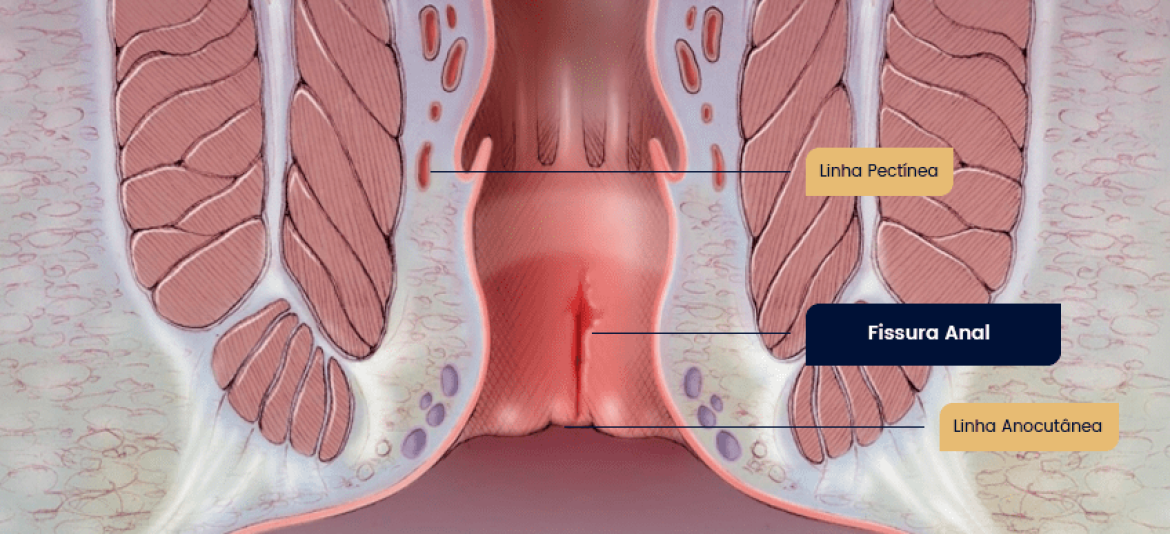 Fissura-anal-final